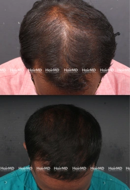 33yrs Male Hairloss Results 6 Months Timeline 6 Sessions HairMD Pune