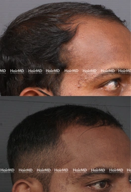 33yrs Male Hairloss Results 6 Months Timeline 6 Sessions HairMD Pune