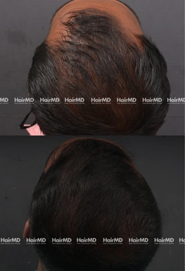 33yrs Male Hairloss Results 6 Months Timeline 6 Sessions HairMD Pune