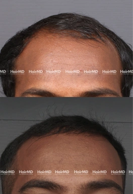 33yrs Male Hairloss Results 6 Months Timeline 6 Sessions HairMD Pune