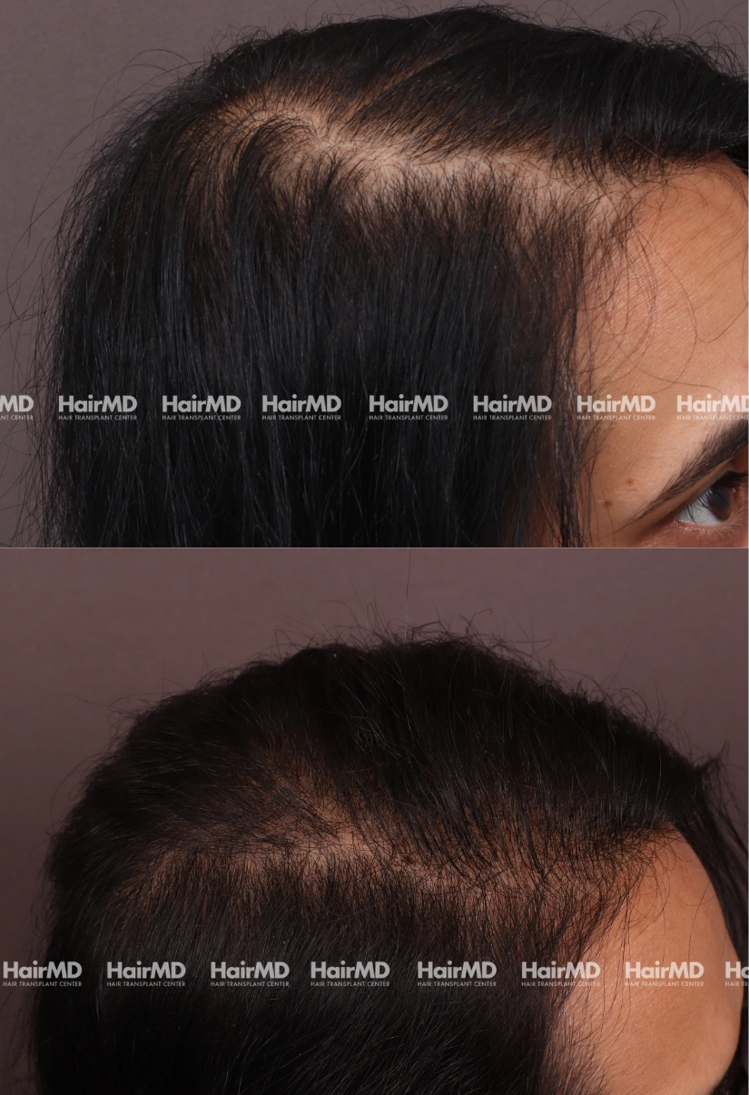 33yrs Nutritional hairloss Results 6 Months Timeline 7 Sessions HairMD Pune