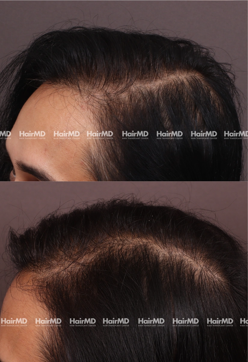 33yrs Nutritional hairloss Results 6 Months Timeline 7 Sessions HairMD Pune