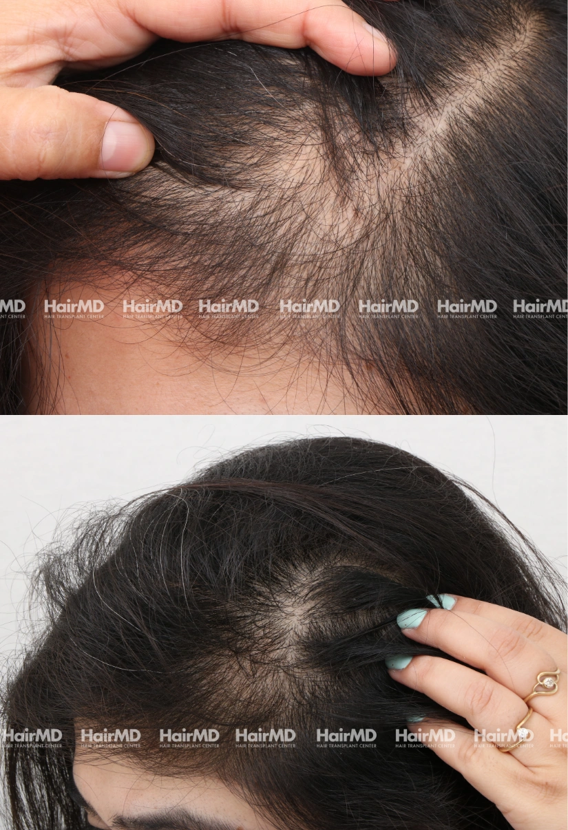 34yrs Female Hairloss Results 6 Months Timeline 7 Sessions HairMD Pune