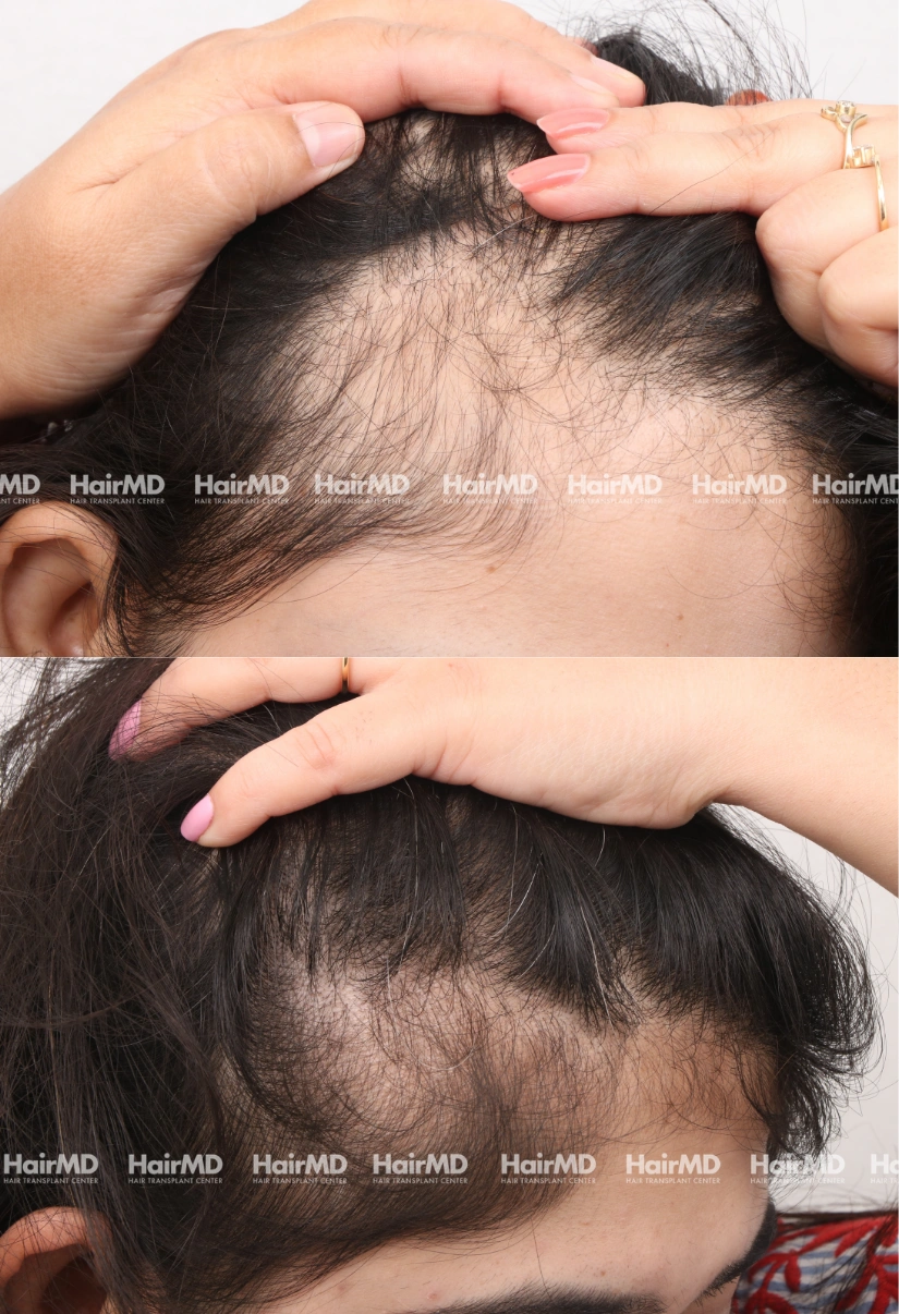 34yrs Female Hairloss Results 6 Months Timeline 7 Sessions HairMD Pune