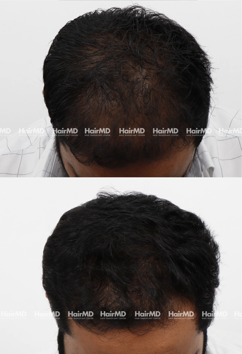 34yrs Nutritional hairloss Results 5 Months Timeline 6 Sessions HairMD Pune