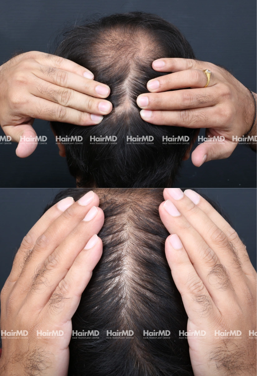 35yrs Alopecia areata Hairloss Results 4 Months Timeline 7 Sessions HairMD Pune