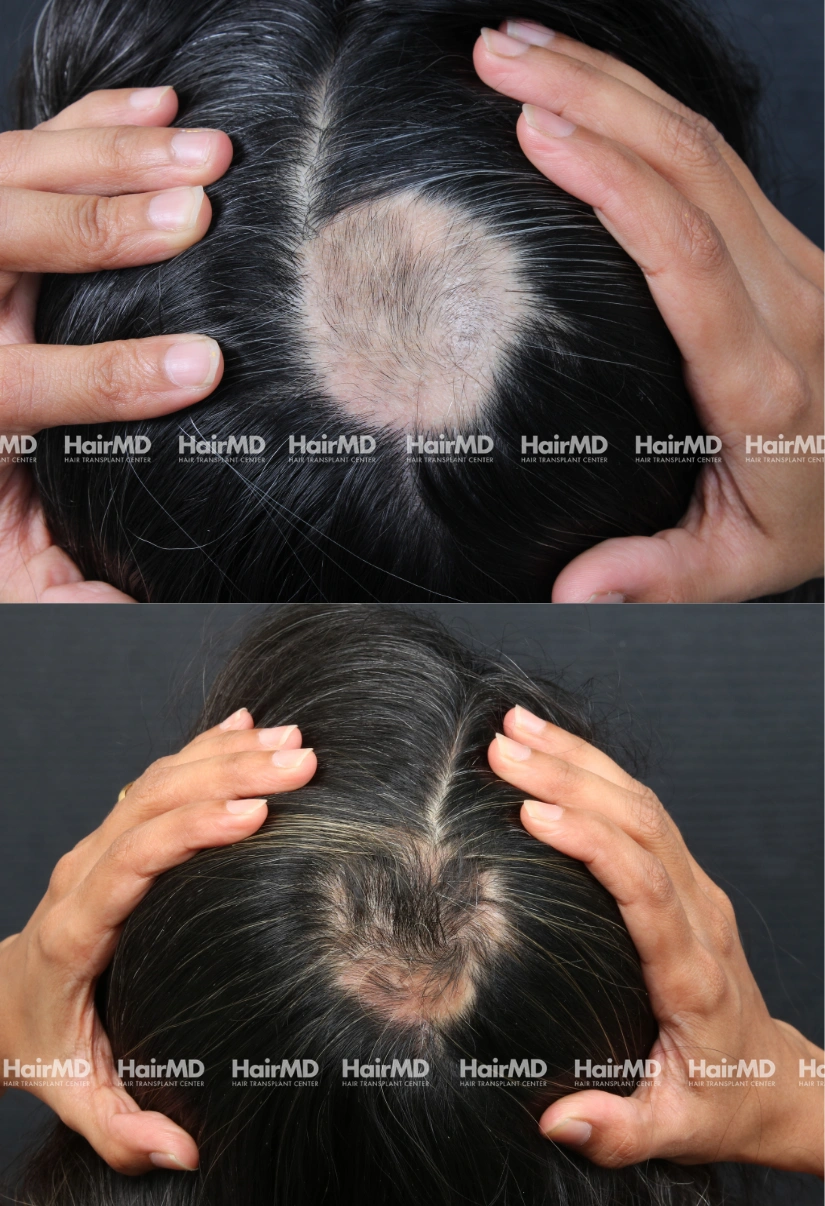 35yrs Alopecia Areata Hairloss Results 6 Months Timeline 6 Sessions HairMD Pune