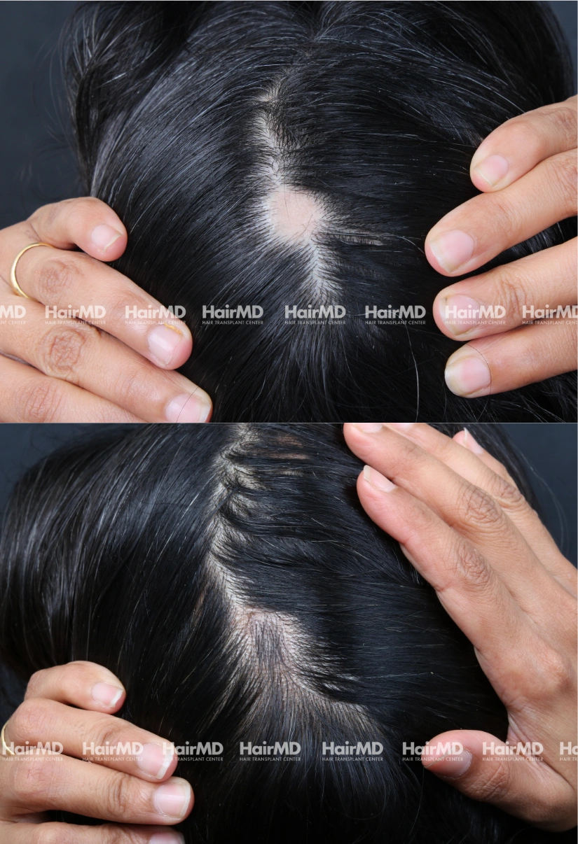 35yrs Alopecia Areata Hairloss Results 6 Months Timeline 6 Sessions HairMD Pune