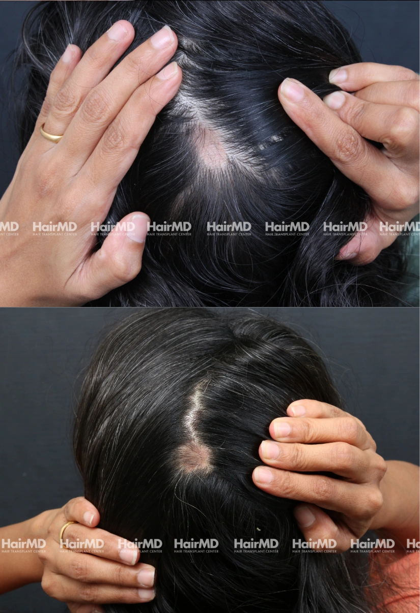 35yrs Alopecia areata Hairloss Results 6 Months Timeline 6 Sessions HairMD Pune