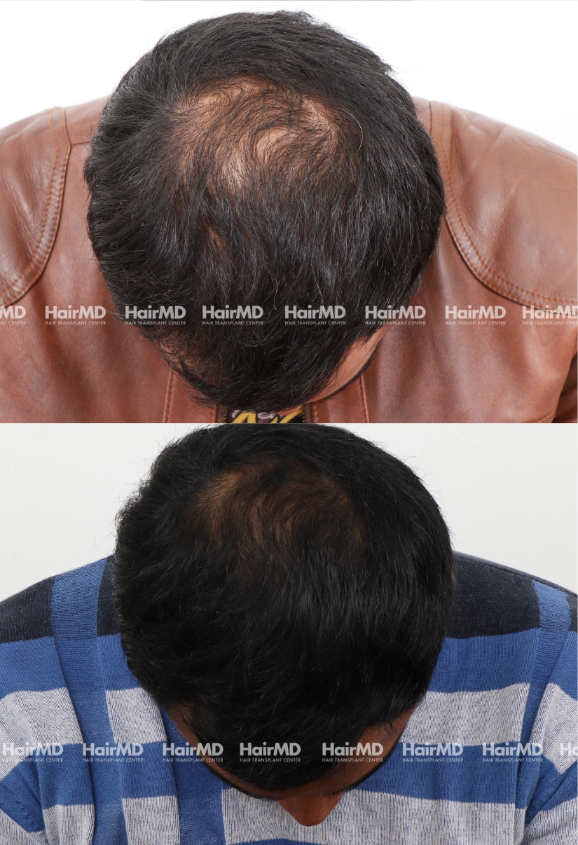 35yrs Baldness Hairloss Results 6 Months Timeline 7 Sessions HairMD Pune