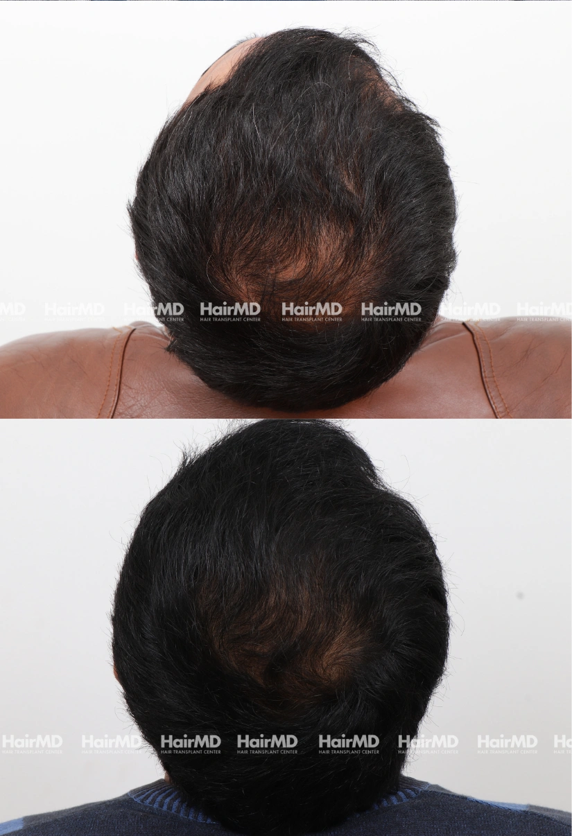 35yrs Baldness Hairloss Results 6 Months Timeline 7 Sessions HairMD Pune