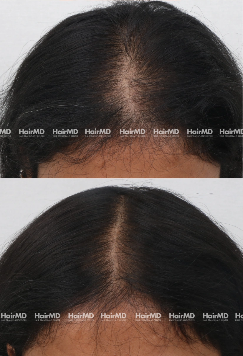 35yrs Female Hairloss Results 6 Months Timeline 6 Sessions HairMD Pune