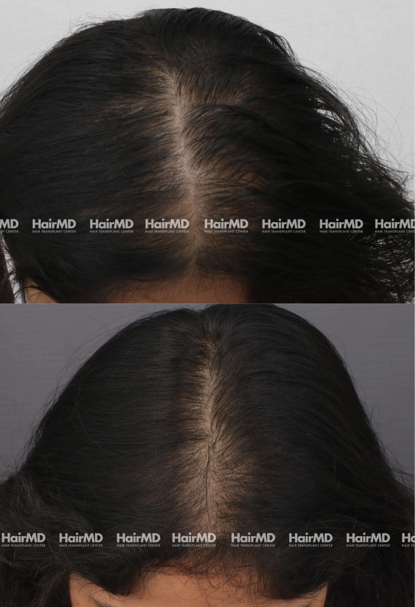 35yrs Female Hairloss Results 6 Months Timeline 6 Sessions HairMD Pune