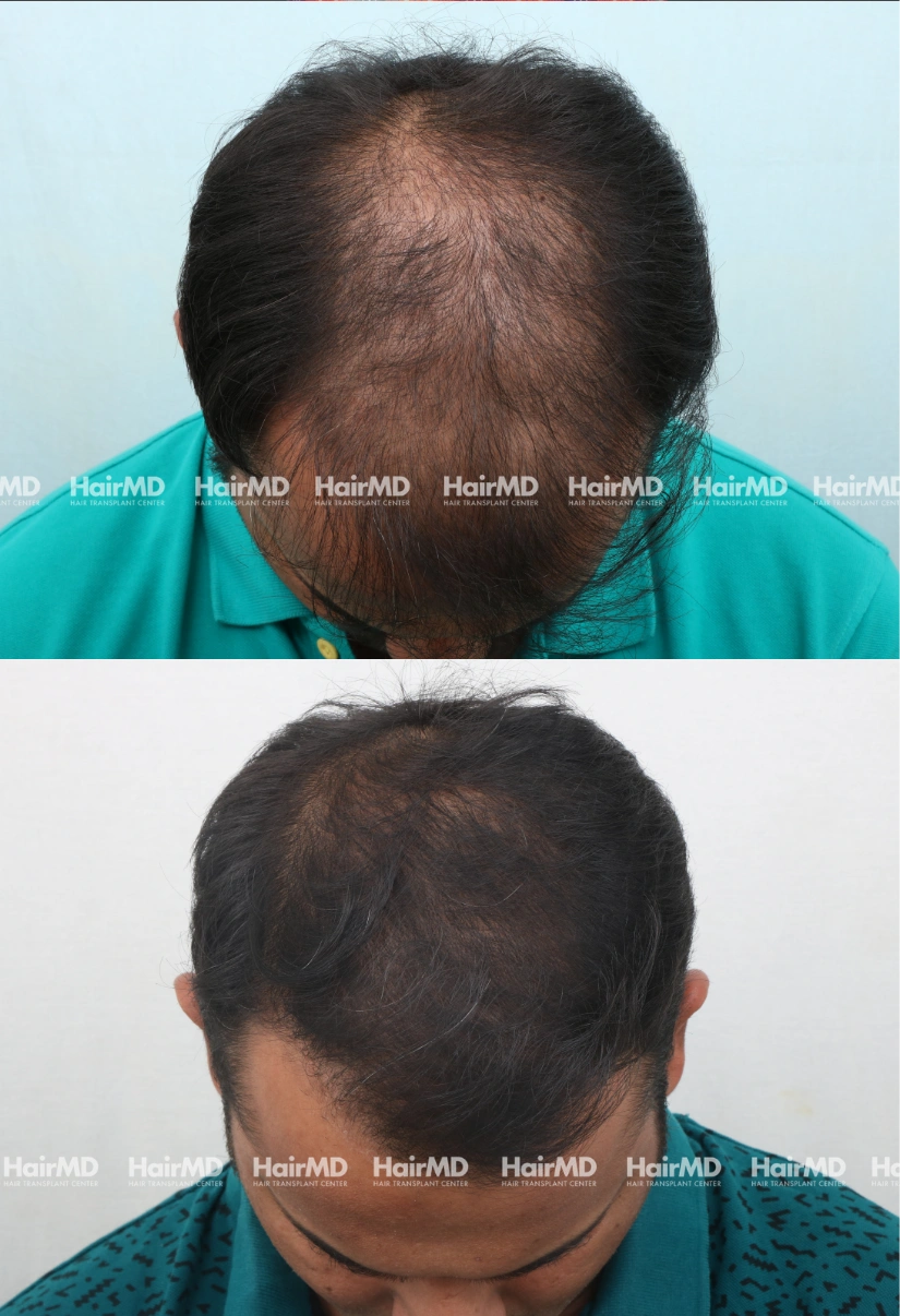 36yrs Baldness Hairloss Results 6 Months Timeline 7 Sessions HairMD Pune