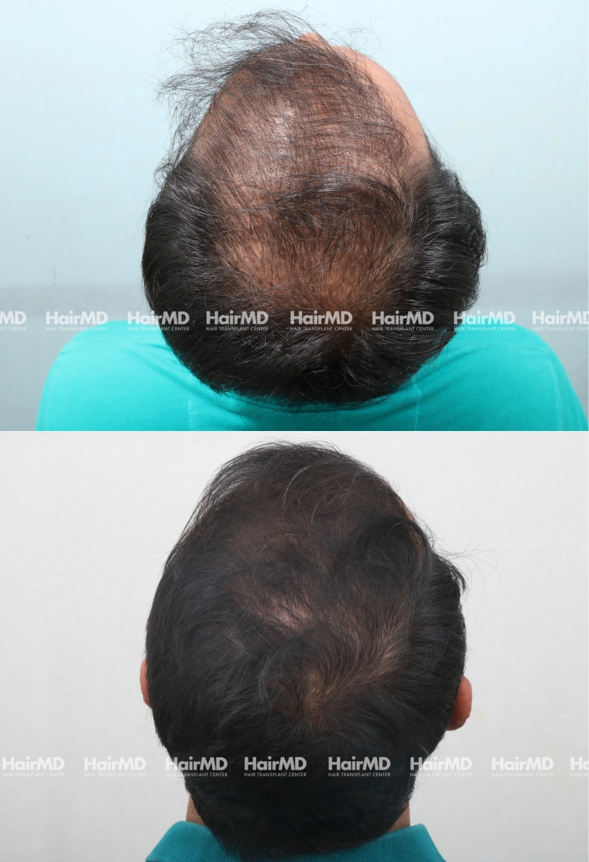 36yrs Baldness Hairloss Results 6 Months Timeline 7 Sessions HairMD Pune