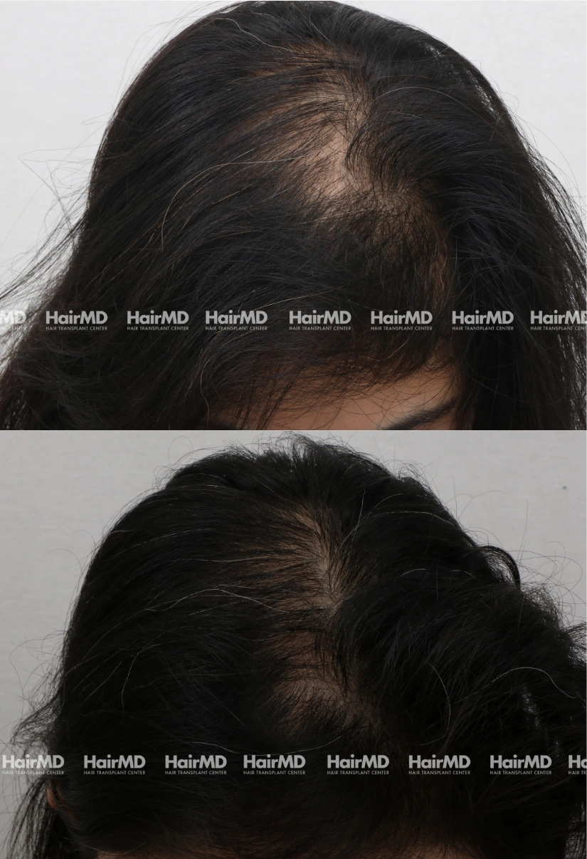 36yrs Female Hairloss Results 6 Months Timeline 7 Sessions HairMD Pune