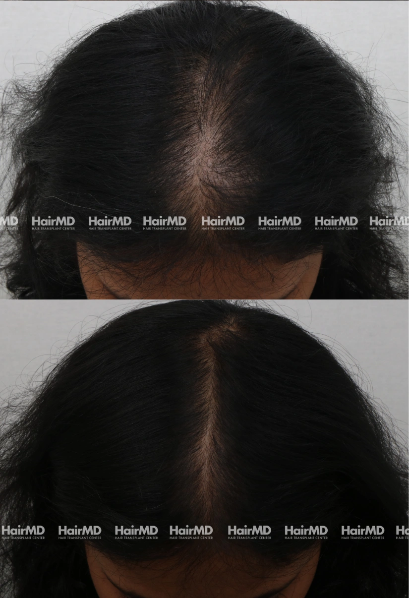 36yrs Female Hairloss Results 6 Months Timeline 7 Sessions HairMD Pune