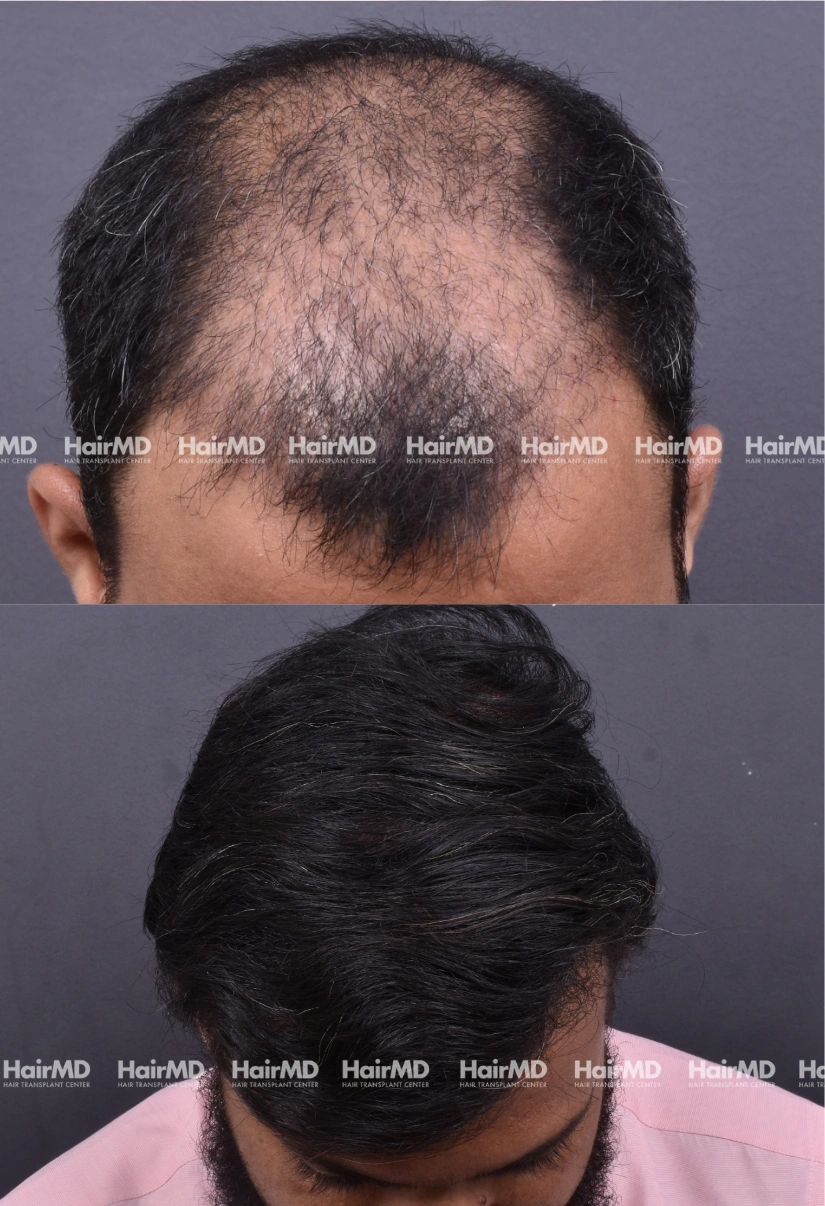 36yrs Male Hairtransplant Results 2 Years 3000-4000 Grafts HairMD Pune