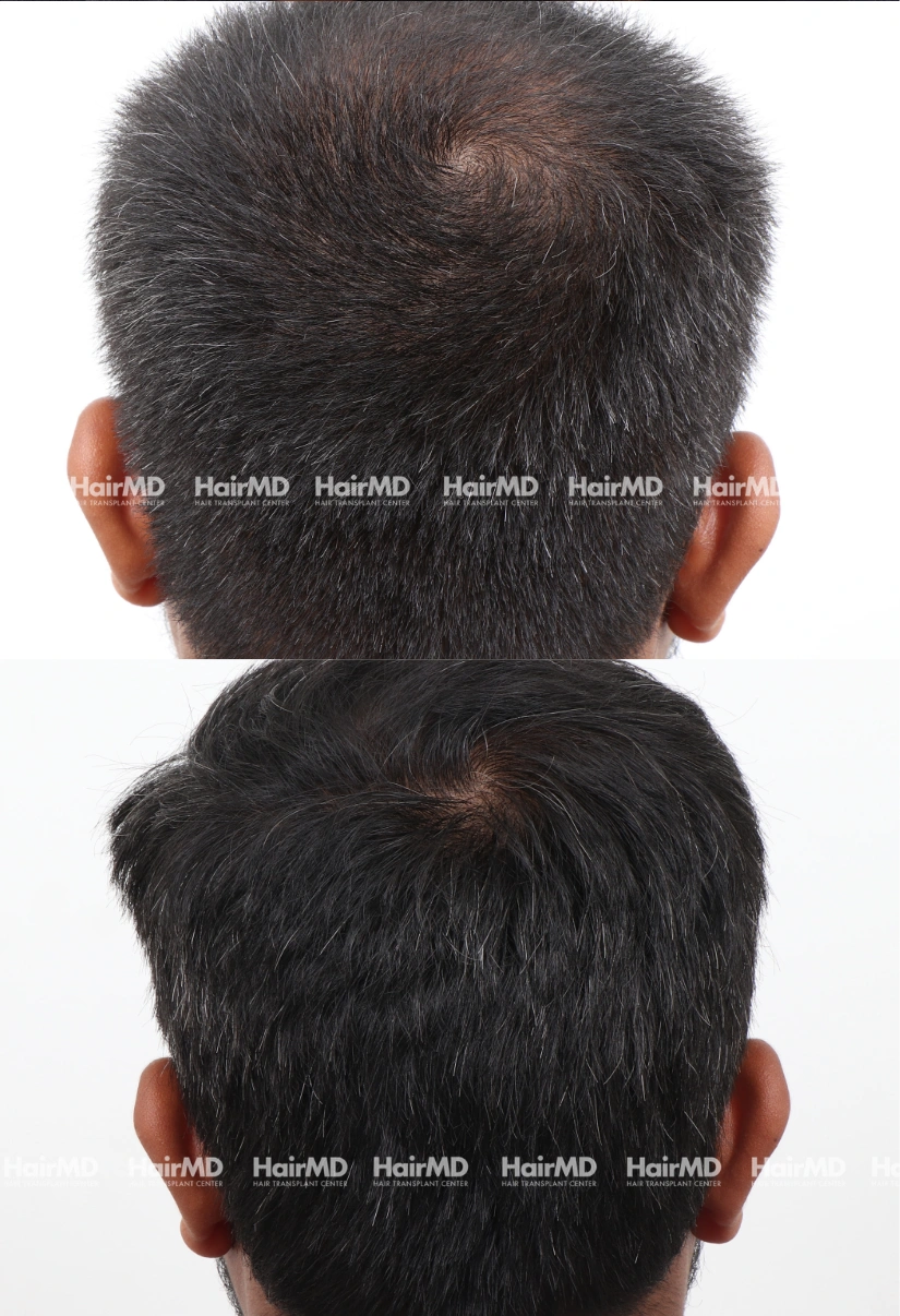 37yrs Nutritional hairloss Results 6 Months Timeline 6 Sessions HairMD Pune