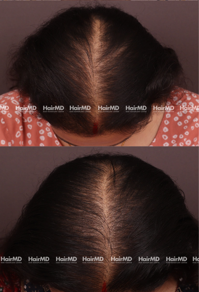 37yrs Nutritional hairloss Results 6 Months Timeline 6 Sessions HairMD Pune