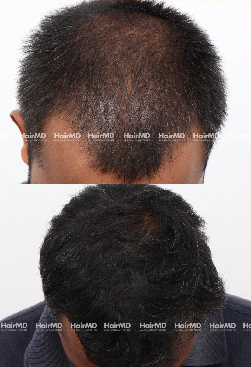 37yrs Nutritional hairloss Results 6 Months Timeline 6 Sessions HairMD Pune