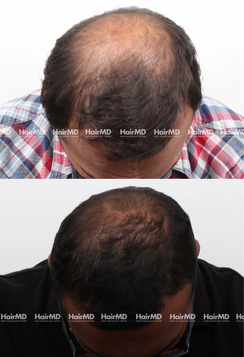 38yrs Baldness Hairloss Results 6 Months Timeline 6 Sessions HairMD Pune