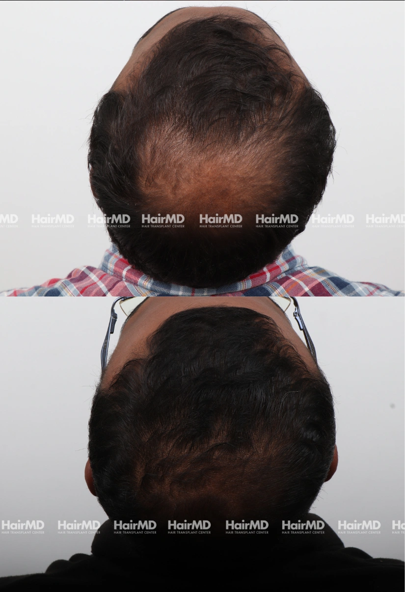 38yrs Baldness Hairloss Results 6 Months Timeline 6 Sessions HairMD Pune