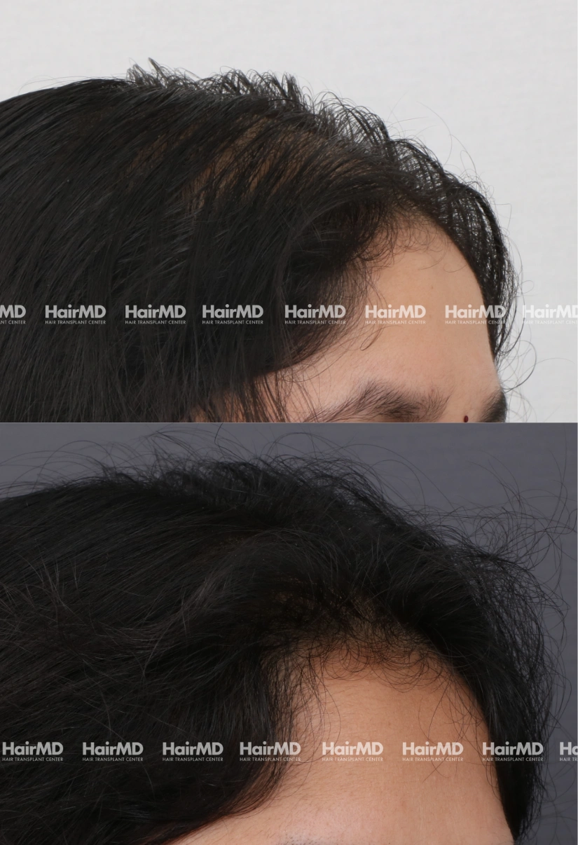 38yrs Female Hairloss Results 6 Months Timeline 7 Sessions HairMD Pune