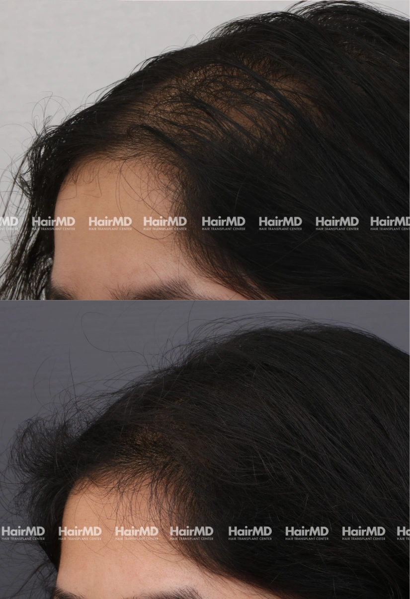 38yrs Female Hairloss Results 6 Months Timeline 7 Sessions HairMD Pune