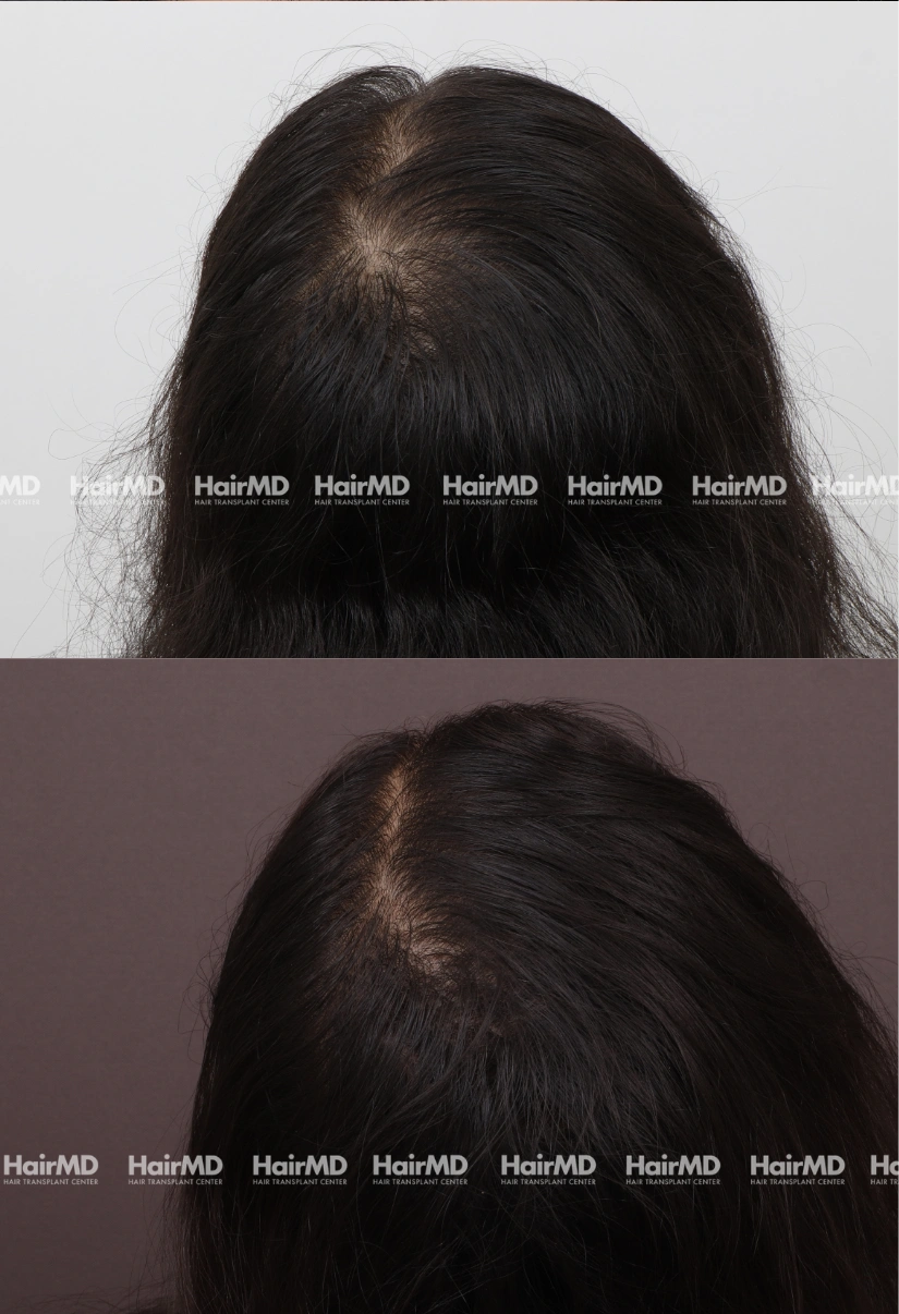 38yrs Female Hairloss Results 6 Months Timeline 7 Sessions HairMD Pune