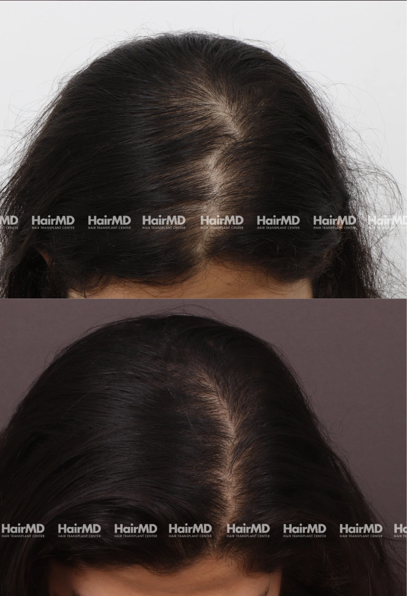 38yrs Female Hairloss Results 6 Months Timeline 7 Sessions HairMD Pune