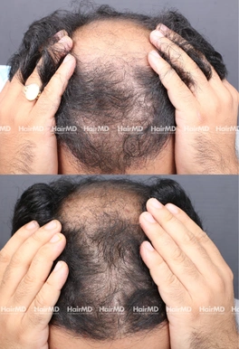 38yrs Male Hairloss Results 6 Months Timeline 7 Sessions HairMD Pune