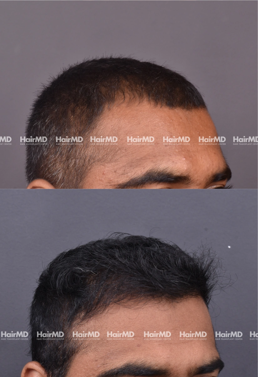 38yrs Male Hairtransplant 2 Years 4000-5000 Grafts HairMD Pune