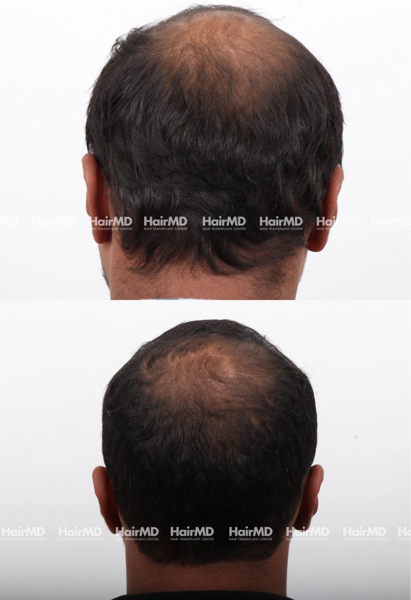 39yrs Baldness Hairloss Results 6 Months Timeline 7 Sessions HairMD Pune