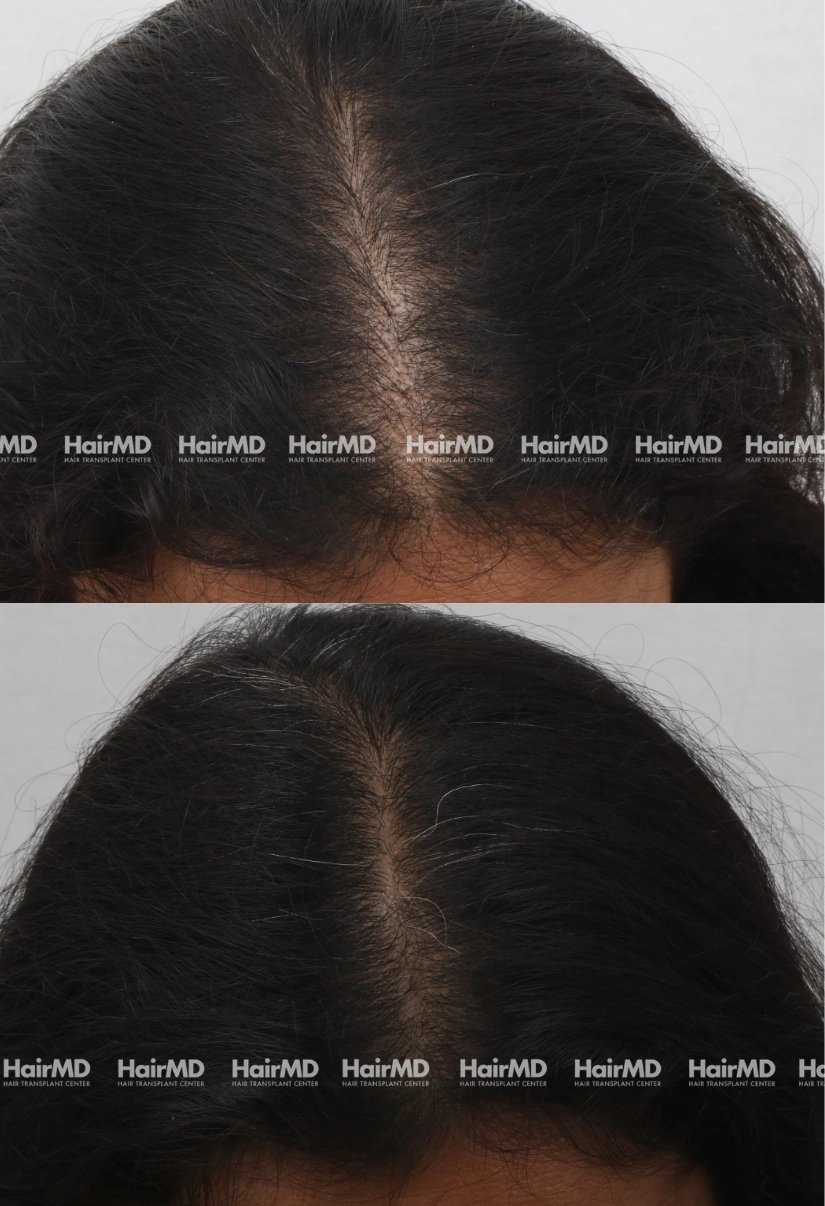 39yrs Female Hairloss Results 5 Months Timeline 6 Sessions HairMD Pune