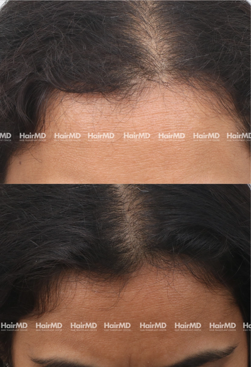 39yrs Female Hairloss Results 5 Months Timeline 6 Sessions HairMD Pune