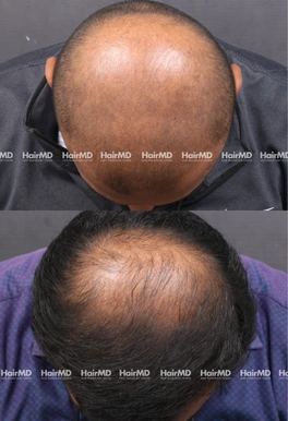 39yrs Male Hairloss Results 6 Months Timeline 7 Sessions HairMD Pune