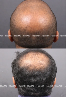 39yrs Male Hairloss Results 6 Months Timeline 7 Sessions HairMD Pune