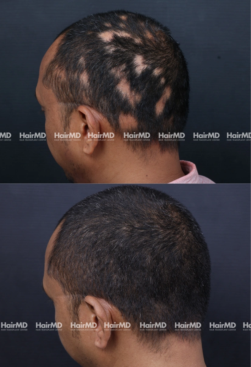 40yrs Alopecia Areata Hairloss Results 6 Months Timeline 7 Sessions HairMD Pune