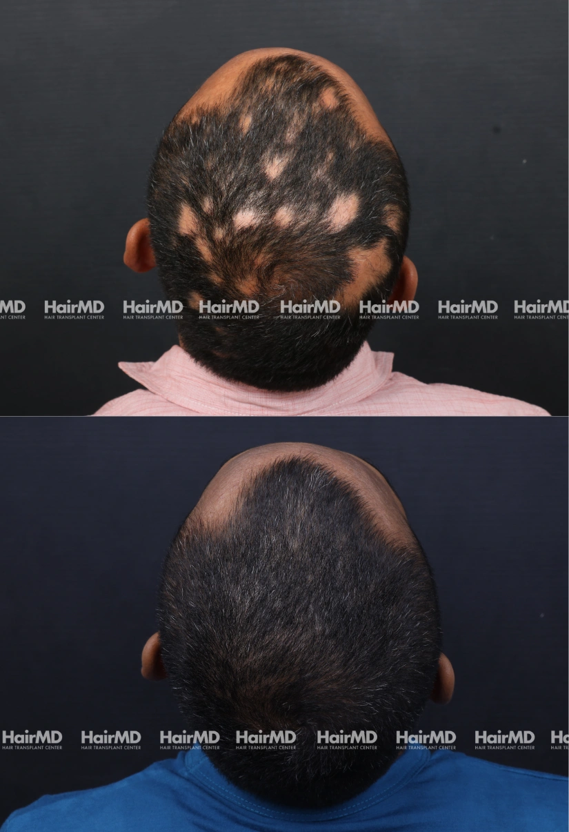 40yrs Alopecia Areata Hairloss Results 6 Months Timeline 7 Sessions HairMD Pune