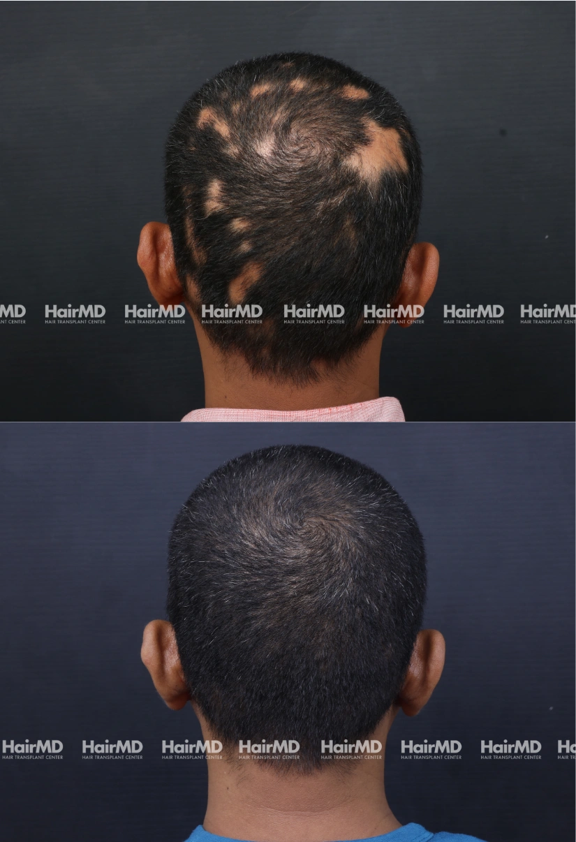 40yrs Alopecia Areata Hairloss Results 6 Months Timeline 7 Sessions HairMD Pune