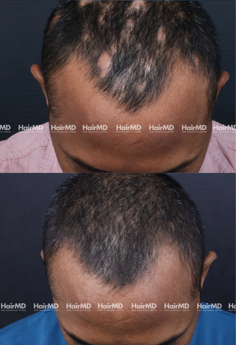 40yrs Alopecia areata Hairloss Results 6 Months Timeline 7 Sessions HairMD Pune