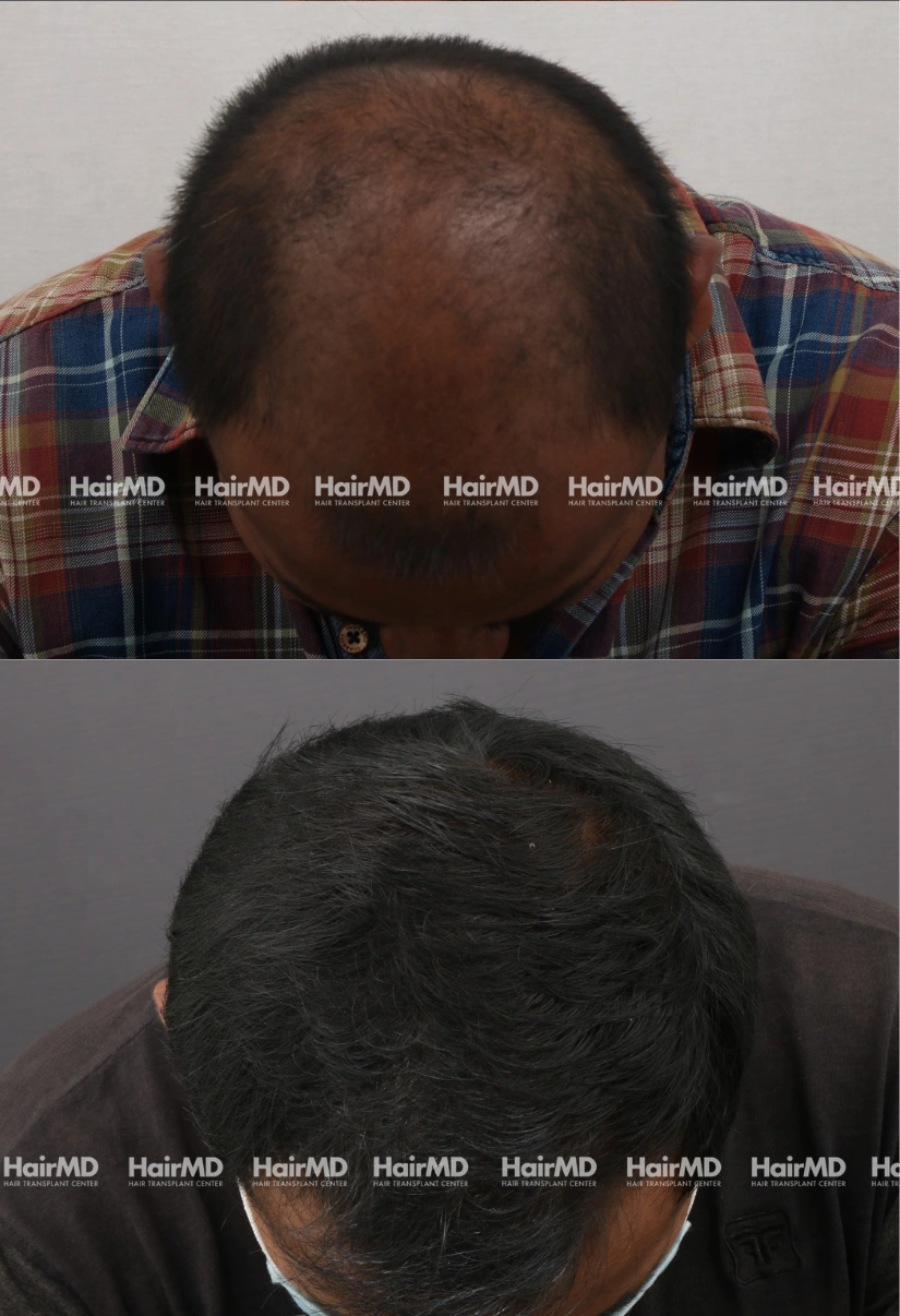 40yrs Baldness Hairloss Results 6 Months Timeline 6 Sessions HairMD Pune