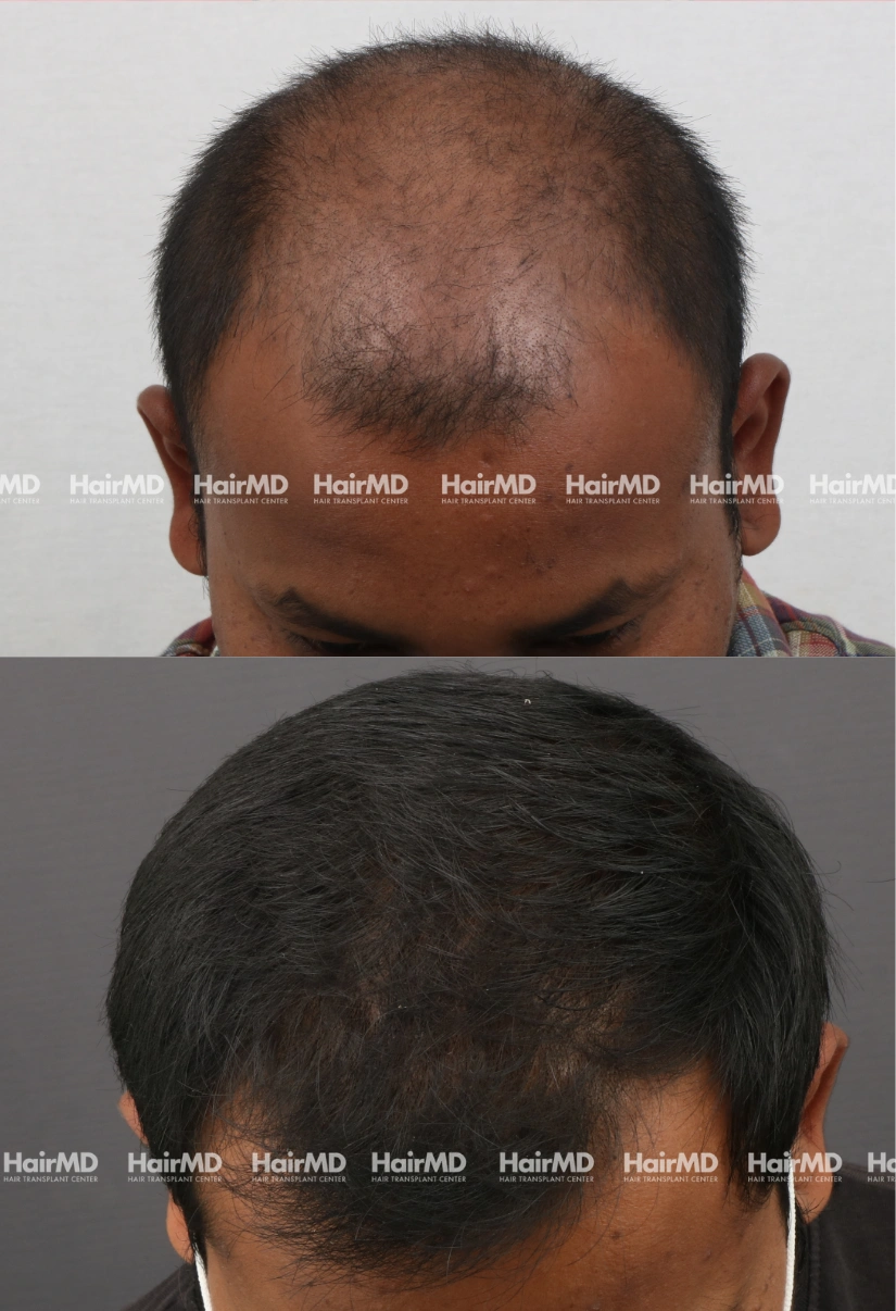 40yrs Baldness Hairloss Results 6 Months Timeline 6 Sessions HairMD Pune