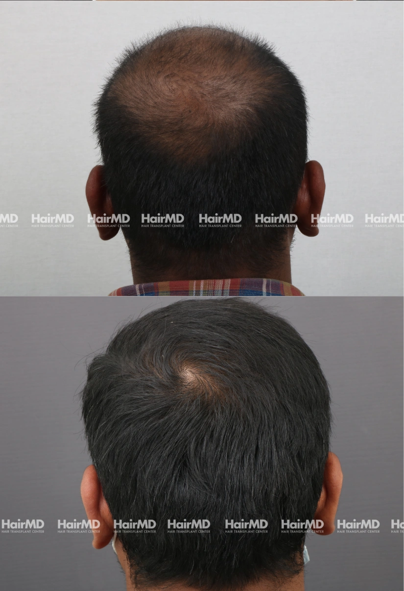 40yrs Baldness Hairloss Results 6 Months Timeline 6 Sessions HairMD Pune