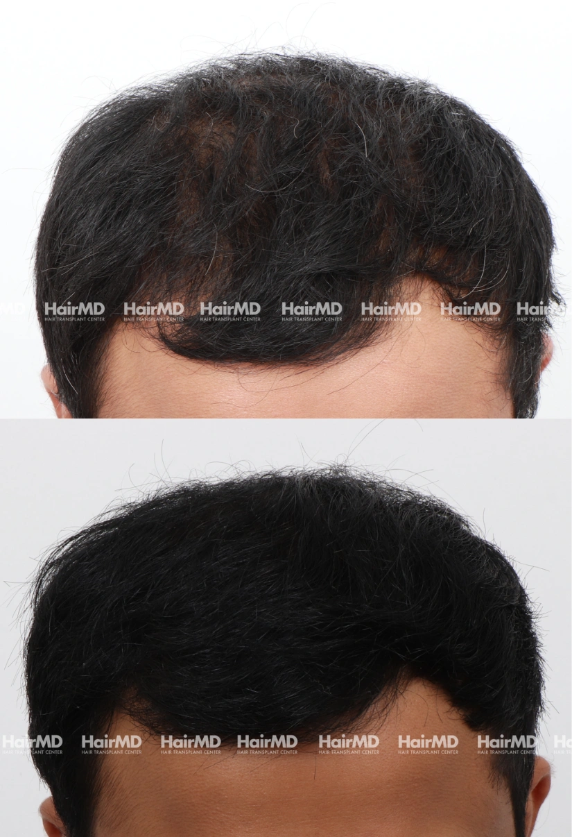 40yrs Baldness Hairloss Results 6 Months Timeline 6 Sessions HairMD Pune