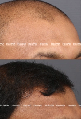 40yrs Male Hairloss Results 6 Months Timeline 7 Sessions HairMD Pune