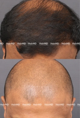 40yrs Male Hairloss Results 6 Months Timeline 7 Sessions HairMD Pune