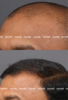 40yrs Male Hairloss Results 6 Months Timeline 7 Sessions HairMD Pune