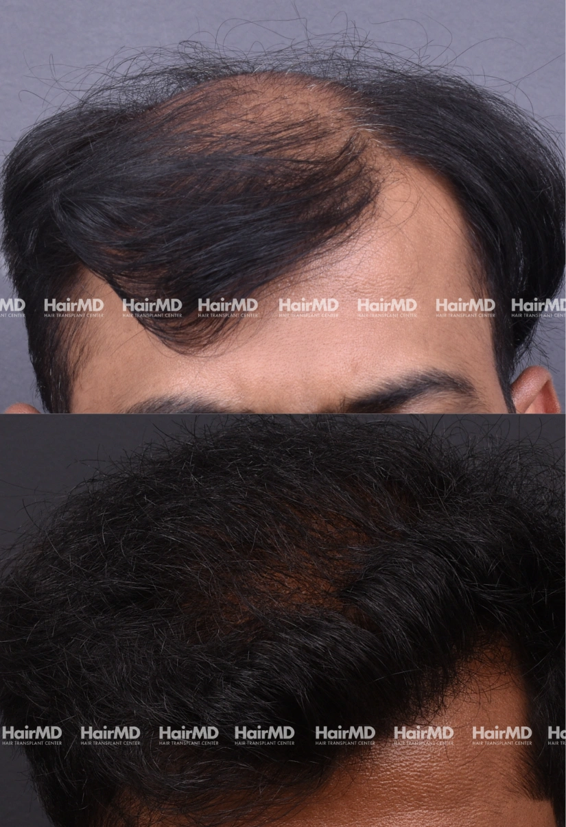 40yrs Male Hairtransplant Results 2 Years 3000 4000 Grafts HairMD Pune